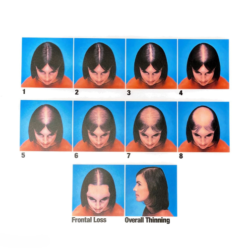Female Hair Loss Poster: Ludwig Scale