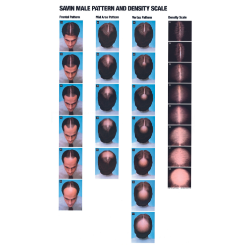 Male Hair Loss Poster: Norwood Scale